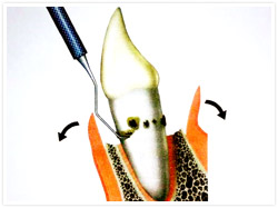 ④ 歯ぐきの手術（歯周外科）